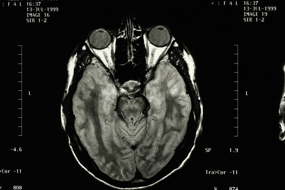 Neurowissenschaft: Kreativität kann dabei helfen, besser mit Schmerz umzugehen